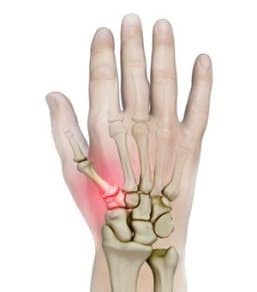 Wrist Scaphoid Nonunion